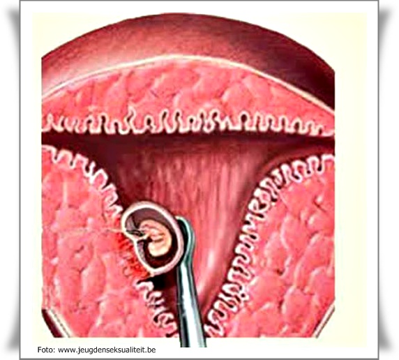 Gambar Uncategorized Gawe Phone Image Gambar Janin Keguguran di Rebanas